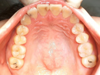 口腔内写真撮影　現在のお口の中の状態を、写真に撮り記録します。