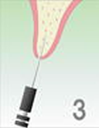O・A・Mインプラントシステム治療の流れ　専用器具（O.A.Mオーギュメーター）を使い、穴を広げます。