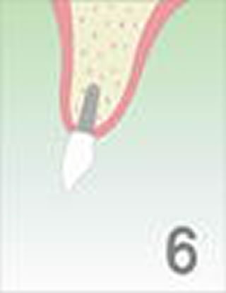 O・A・Mインプラントシステム治療の流れ　骨とインプラント体が結合したら歯がはいります。