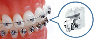 デイモンシステム　ハイテクブラケットと最先端ワイヤーにより歯列矯正に最適な力を実現。