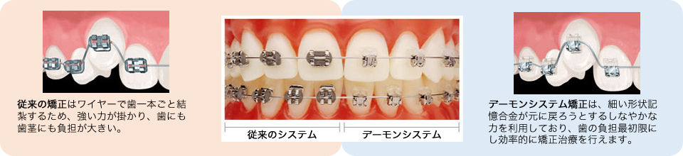 従来の矯正治療装置との比較