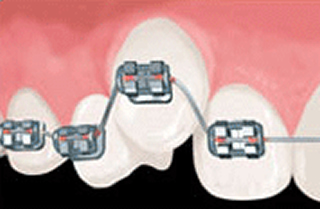 従来のシステム　従来の矯正はワイヤーで歯一本まるごと結紮する。